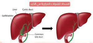  الوقاية من التهاب القناة المرارية... نصائح للحفاظ على صحة المرارة
