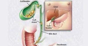  الوقاية من التهاب القناة المرارية... نصائح للحفاظ على صحة المرارة