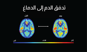 تهدئة الزهايمر.. كيف تؤثر الأدوية على السكتة الدماغية وتحسين جودة الحياة؟