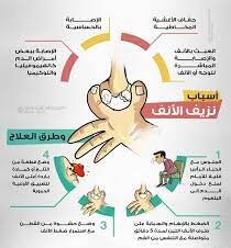 نزيف الأنف: أسبابه وكيفية علاجه