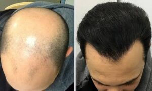 شروط زراعة الشعر.. العوامل الأساسية لنجاح الزراعة